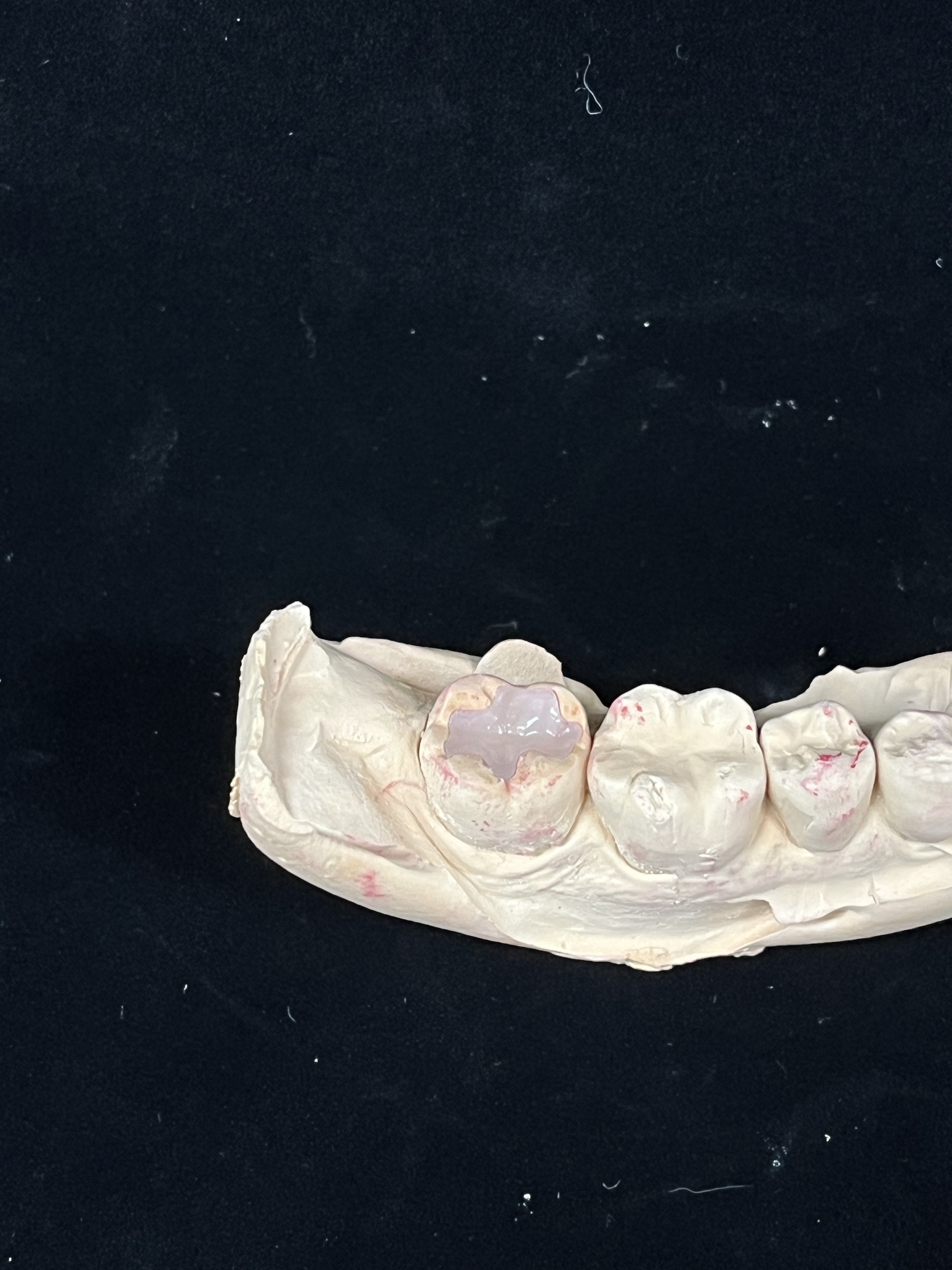 지르코니아 크라운 교합면